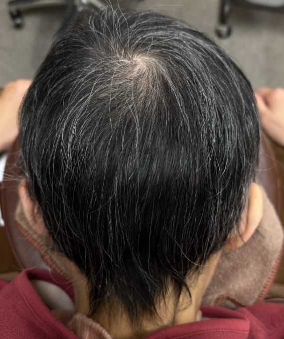 50代女性:汎発性脱毛症 施術後