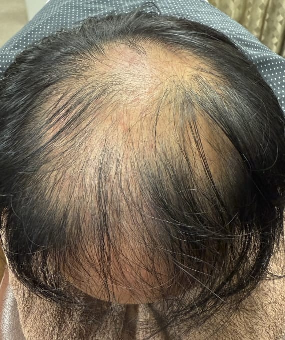 40代男性:薄毛の進行 施術前