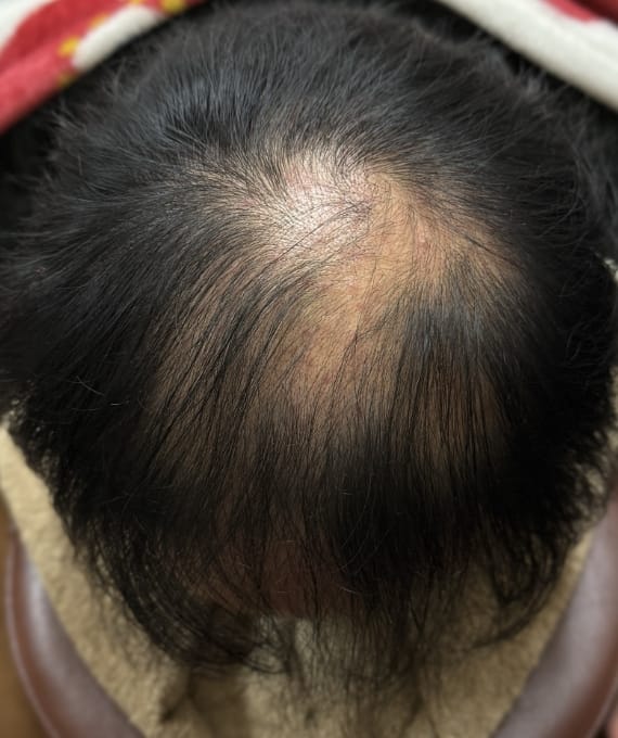 40代男性:薄毛の進行 施術後