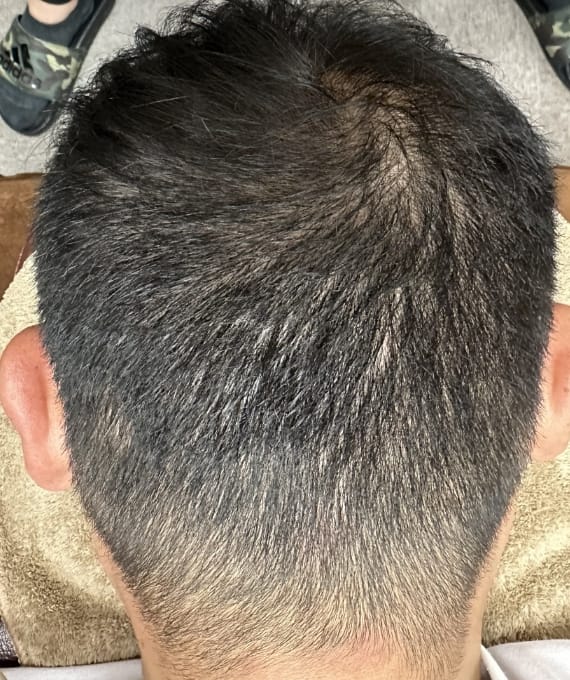 40代男性:多発性円形脱毛症 施術後